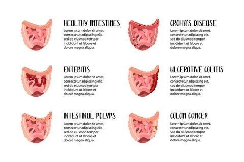 Intestines diseases. Enteritis, ulcerative colitis, Crohn's disease, polyp, c Stock Illustration