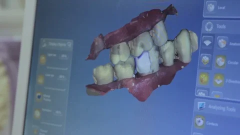 Intra-Oral camera teeth display on screen Stock Footage 73530723