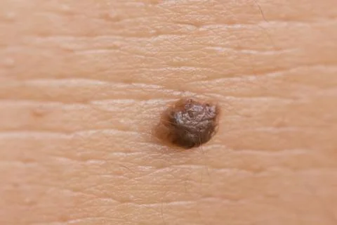 Intradermal nevus Foto stock