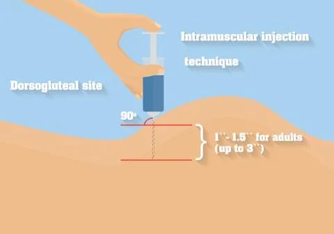 Intramuscular injection technique vector illustration. Stock Illustration