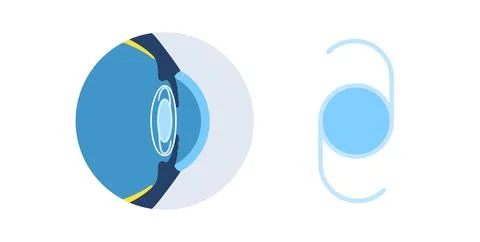 Intraocular lens poster Stock Illustration