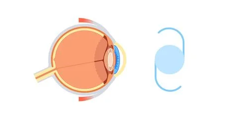 Intraocular lens poster Illustrazione stock