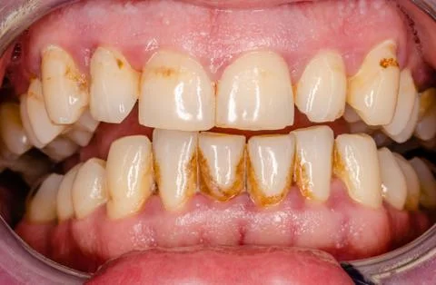 Intraoral view of frontal teeth with stains and tartar Stock Photos