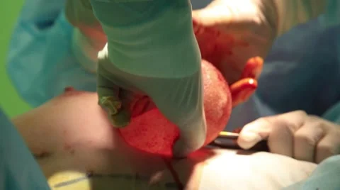 The introduction of the implant in the chest Stock Footage 55672519