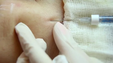 Introduction of injection under the skin Stock Footage 83547276