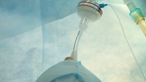 Intubated patient connected to an artificial lung ventilation unit. Stock Footage 127300707
