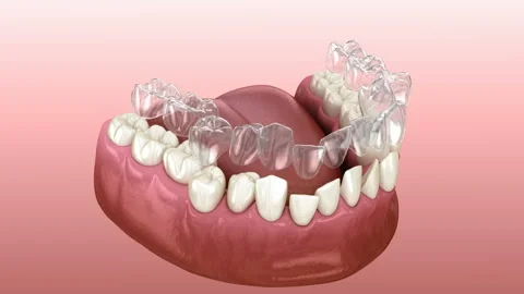 Invisible Aligners For Dental Correction In A Box Stock Photo