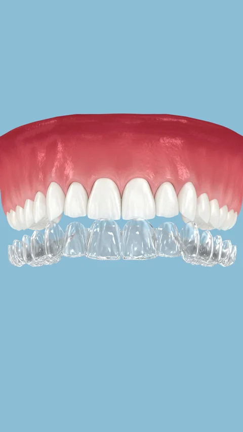 Invisalign braces or invisible retainer. Dental 3D animation Stock Footage 316544116