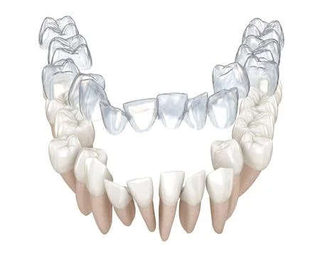 Invisalign braces or invisible retainer make bite correction. Stock Illustration