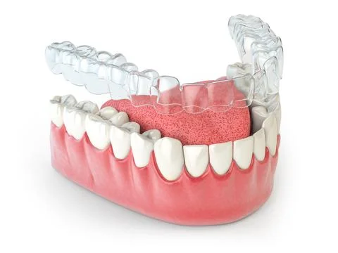 Invisalign invisible retainer  or braces with lawer jaw islated on white. Stock Illustration