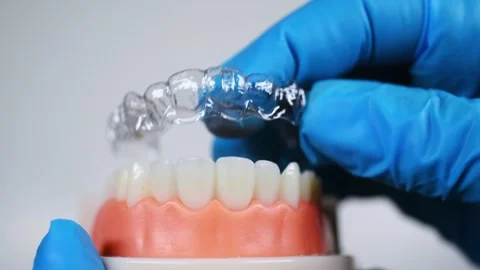 Invisible and removable aligners for teeth alignment Stock Footage 304363915