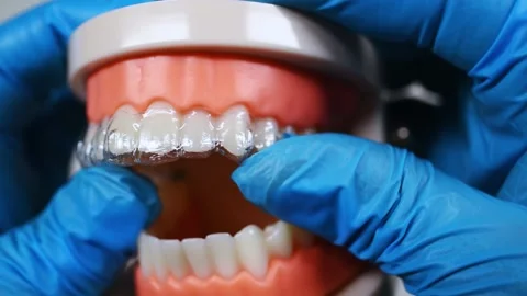 Invisible and removable aligners for teeth alignment Stock Footage 304364020