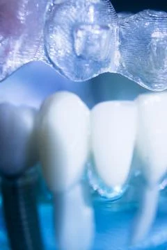 Invisible bracket aligners Stock Photos