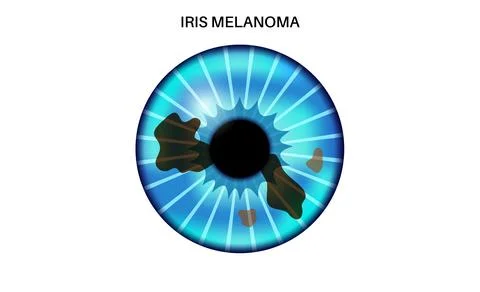 Iris melanoma anatomy Stock Illustration