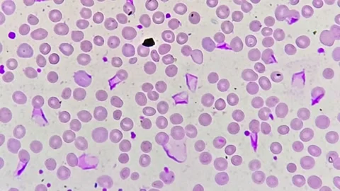 Iron deficiency anemia Video stock 337723051
