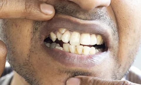 Irregular teeth Stock Photos