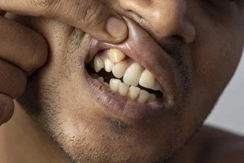 Irregular teeth Foto stock