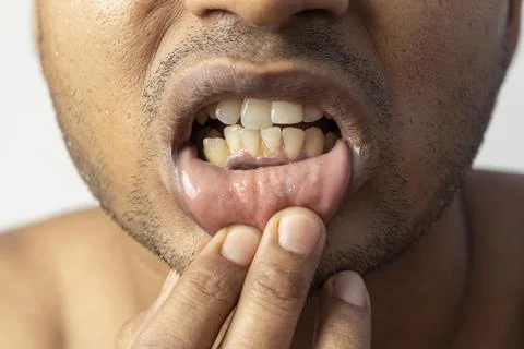 Irregular teeth Stock-Fotos