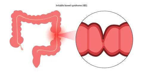 Irritable bowel syndrome Stock Illustration