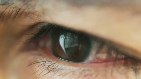 Irritated eye Video stock 43126137