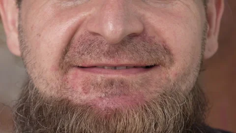Irritation after shaving on a man's beard. Stock Footage 284002380