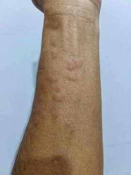 Irritation arm Stock Photos