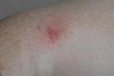 Irritation from an insect bite. Trace irritation from a bite by an unknown in Foto stock