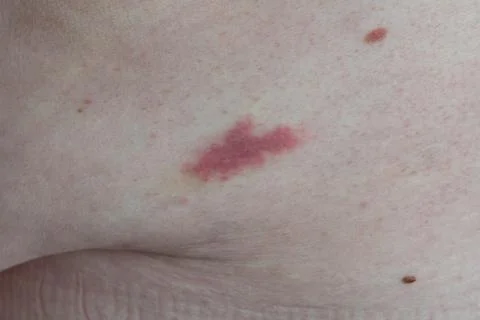 Irritation from an insect bite. Trace irritation from a bite by an unknown in Foto stock