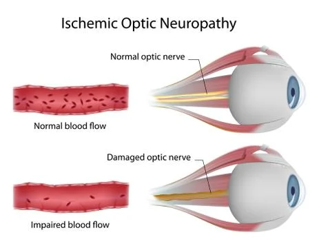 Ischemic optic neuropathy Stock Illustration