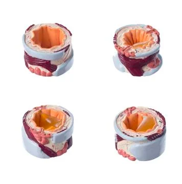 Isolated cross section of human windpipe disorders Stock Photos