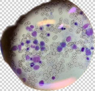 Isolated cutout of leukemia in microscope Stock Photos