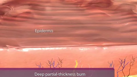 It may be red due to extravasation from damaged vessels due to damage to the  Stock Illustration