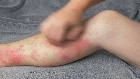Itching leg rash Stock Footage 139892534