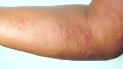 Rash with transparent small blisters on , Stock Video