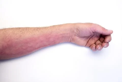 Itchy arm Foto stock
