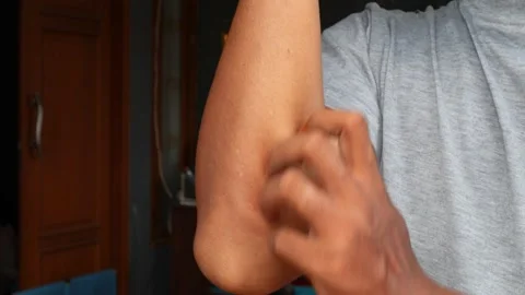 Itchy Video stock 332527996