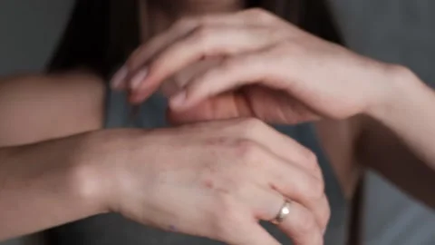 Itchy hands with eczema 스톡 동영상 310914252