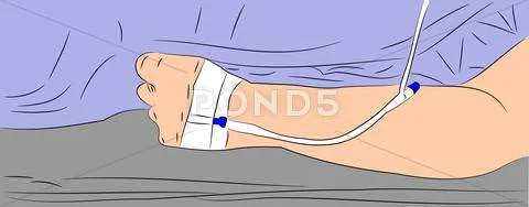 IV in Arm Stock Illustration