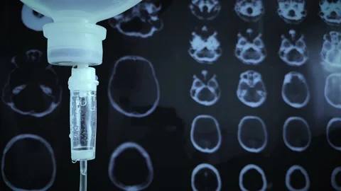 IV drip infusion for Brain disease Stock-Footage 158760410