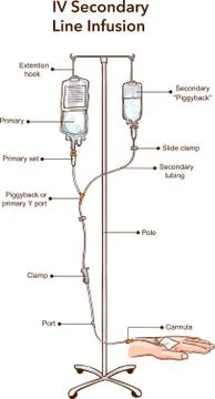 IV Secondary Line Infusion vector illustration Stock Illustration