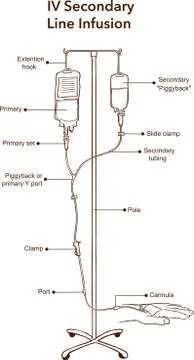 IV Secondary Line Infusion vector illustration Stock Illustration