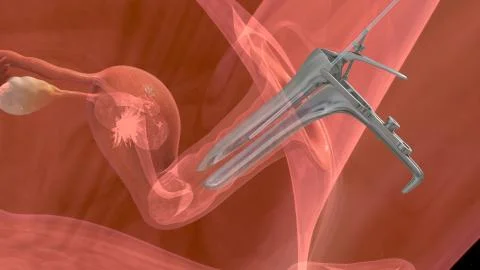 IVF Embryo transfer Illustrazione stock