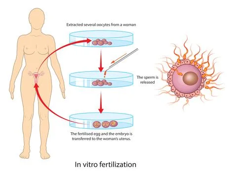 IVF Procedure Diagram Stock Illustration