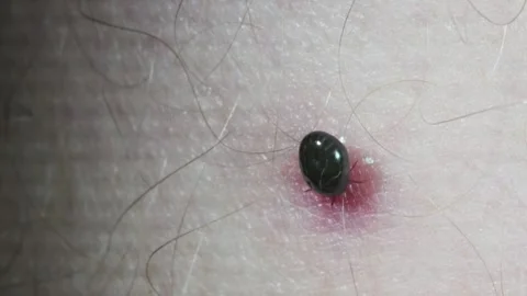 Ixodes ricinus on the human leg,  Ixodes, Amazzonia, Brasil, Stock Footage 345664195