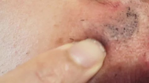 Japanese man's beard begins to fall out after laser hair removal Stock Footage 326082798