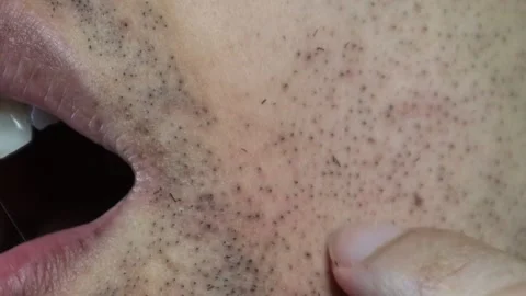 Japanese man's beard begins to fall out after laser hair removal Stock Footage 326083210