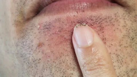 Japanese man's beard begins to fall out after laser hair removal Stock Footage 326083465