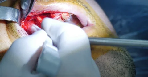 Jaw bone surgery addition Stock Footage 70172142