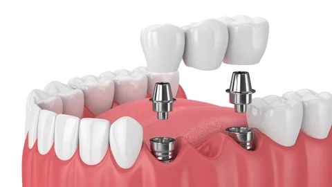 Jaw with implants supporting dental bridge over white background Stock Footage 133546009