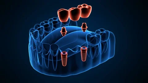Jaw with implants supporting dental bridge with x-ray effect over dark blue Video stock 158615243
